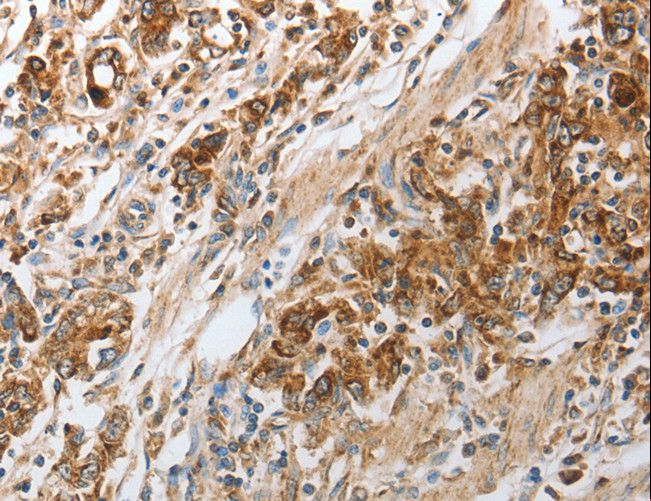 NPY1R Antibody - Immunohistochemistry of paraffin-embedded Human gastric cancer using NPY1R Polyclonal Antibody at dilution of 1:30.