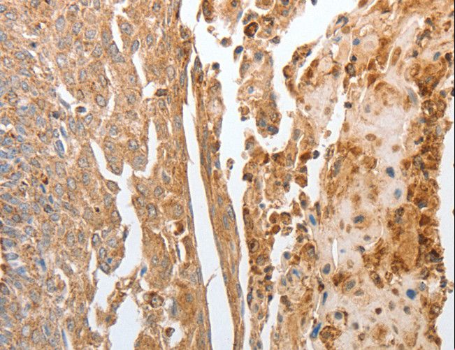 NPY1R Antibody - Immunohistochemistry of paraffin-embedded Human cervical cancer using NPY1R Polyclonal Antibody at dilution of 1:30.