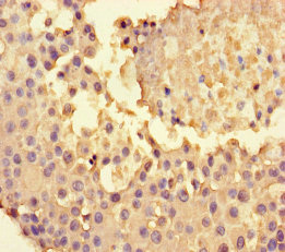 NPY4R / PPYR1 Antibody - Immunohistochemistry of paraffin-embedded human breast cancer using NPY4R Antibody at dilution of 1:100