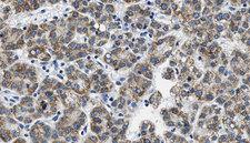 NPY5R Antibody - 1:100 staining human liver carcinoma tissues by IHC-P. The sample was formaldehyde fixed and a heat mediated antigen retrieval step in citrate buffer was performed. The sample was then blocked and incubated with the antibody for 1.5 hours at 22°C. An HRP conjugated goat anti-rabbit antibody was used as the secondary.