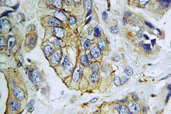 NPY5R Antibody - IHC of NPY5-R (M264) pAb in paraffin-embedded human breast carcinoma tissue.