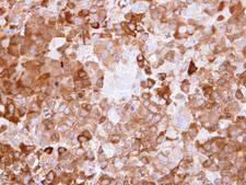 NQO1 Antibody - IHC of paraffin-embedded CL1-0 xenograft using NQO1 antibody at 1:500 dilution.