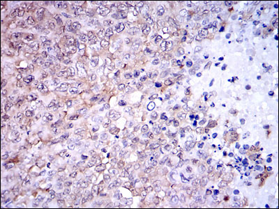 NQO1 Antibody - IHC of paraffin-embedded ovarian cancer tissues using NQO1 mouse monoclonal antibody with DAB staining.