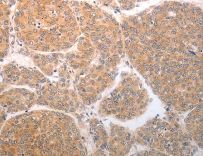 NQO1 Antibody - Immunohistochemistry of paraffin-embedded Human liver cancer using NQO1 Polyclonal Antibody at dilution of 1:25.