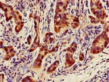 NQO1 Antibody - Immunohistochemistry of paraffin-embedded human pancreatic cancer at dilution of 1:100