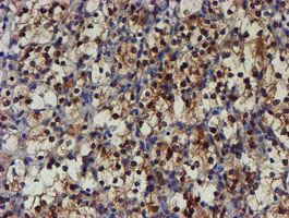 NQO2 Antibody - IHC of paraffin-embedded Carcinoma of Human kidney tissue using anti-NQO2 mouse monoclonal antibody.