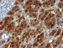 NQO2 Antibody - IHC of paraffin-embedded Carcinoma of Human liver tissue using anti-NQO2 mouse monoclonal antibody.