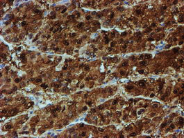 NQO2 Antibody - IHC of paraffin-embedded Carcinoma of Human liver tissue using anti-NQO2 mouse monoclonal antibody. (Heat-induced epitope retrieval by 10mM citric buffer, pH6.0, 100C for 10min).