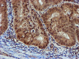NQO2 Antibody - IHC of paraffin-embedded Adenocarcinoma of Human endometrium tissue using anti-NQO2 mouse monoclonal antibody. (Heat-induced epitope retrieval by 10mM citric buffer, pH6.0, 100C for 10min).