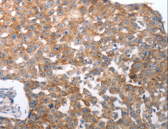 NQO2 Antibody - Immunohistochemistry of paraffin-embedded Human breast cancer using NQO2 Polyclonal Antibody at dilution of 1:50.