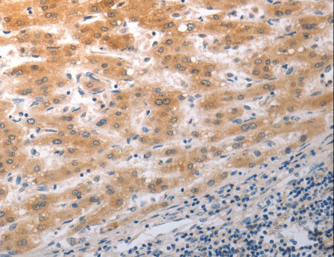 NQO2 Antibody - Immunohistochemistry of paraffin-embedded Human liver cancer using NQO2 Polyclonal Antibody at dilution of 1:50.