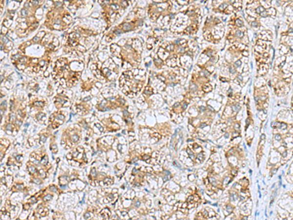 NQO2 Antibody - Immunohistochemistry of paraffin-embedded Human liver cancer tissue  using NQO2 Polyclonal Antibody at dilution of 1:70(×200)
