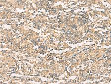 NQO2 Antibody - Immunohistochemistry of paraffin-embedded Human tonsil tissue  using NQO2 Polyclonal Antibody at dilution of 1:50(×200)