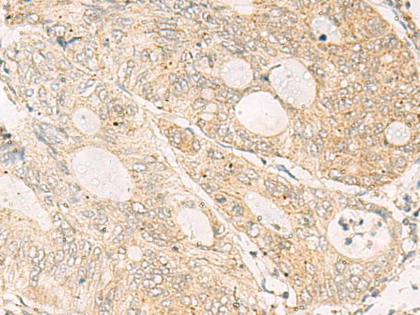 NQO2 Antibody - Immunohistochemistry of paraffin-embedded Human colorectal cancer tissue  using NQO2 Polyclonal Antibody at dilution of 1:50(×200)