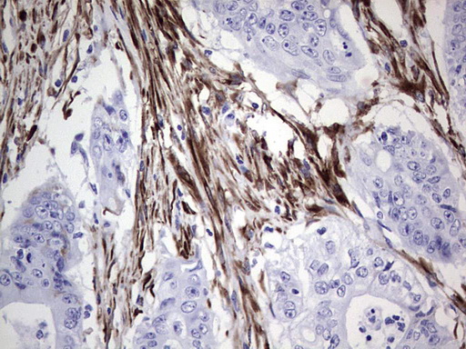 NR0B1 / DAX1 Antibody - Immunohistochemical staining of paraffin-embedded Adenocarcinoma of Human colon tissue using anti-NR0B1 mouse monoclonal antibody. (Heat-induced epitope retrieval by 1 mM EDTA in 10mM Tris, pH8.5, 120C for 3min,