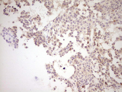 NR0B2 Antibody - Immunohistochemical staining of paraffin-embedded Carcinoma of Human lung tissue using anti-NR0B2 mouse monoclonal antibody. (Heat-induced epitope retrieval by Tris-EDTA, pH8.0) Dilution: 1:150