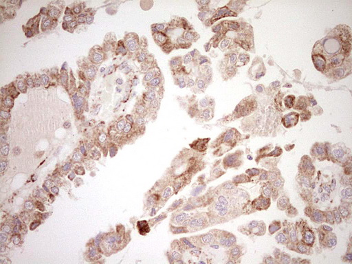 NR0B2 Antibody - Immunohistochemical staining of paraffin-embedded Adenocarcinoma of Human ovary tissue using anti-NR0B2 mouse monoclonal antibody. (Heat-induced epitope retrieval by Tris-EDTA, pH8.0) Dilution: 1:150