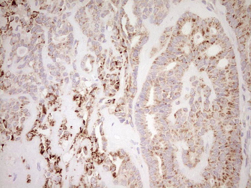 NR0B2 Antibody - Immunohistochemical staining of paraffin-embedded Carcinoma of Human thyroid tissue using anti-NR0B2 mouse monoclonal antibody. (Heat-induced epitope retrieval by Tris-EDTA, pH8.0) Dilution: 1:150