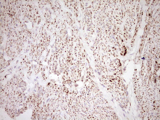 NR0B2 Antibody - Immunohistochemical staining of paraffin-embedded Adenocarcinoma of Human endometrium tissue using anti-NR0B2 mouse monoclonal antibody. (Heat-induced epitope retrieval by Tris-EDTA, pH8.0) Dilution: 1:150