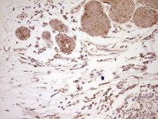 NR0B2 Antibody - Immunohistochemical staining of paraffin-embedded Adenocarcinoma of Human breast tissue using anti-NR0B2 mouse monoclonal antibody. (Heat-induced epitope retrieval by Tris-EDTA, pH8.0) Dilution: 1:150
