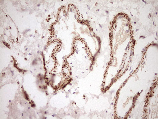 NR0B2 Antibody - Immunohistochemical staining of paraffin-embedded Carcinoma of Human bladder tissue using anti-NR0B2 mouse monoclonal antibody. (Heat-induced epitope retrieval by Tris-EDTA, pH8.0) Dilution: 1:150