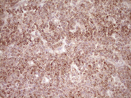 NR0B2 Antibody - Immunohistochemical staining of paraffin-embedded Human lymphoma tissue using anti-NR0B2 mouse monoclonal antibody. (Heat-induced epitope retrieval by Tris-EDTA, pH8.0) Dilution: 1:150