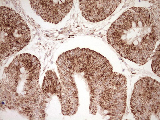 NR0B2 Antibody - Immunohistochemical staining of paraffin-embedded Adenocarcinoma of Human colon tissue using anti-NR0B2 mouse monoclonal antibody. (Heat-induced epitope retrieval by Tris-EDTA, pH8.0) Dilution: 1:150