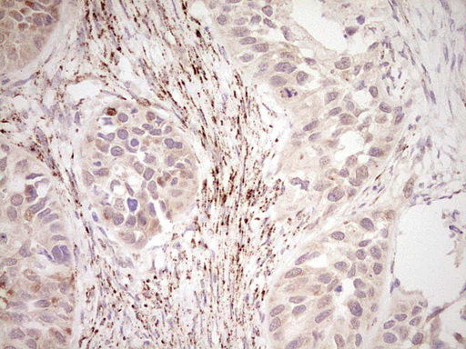 NR0B2 Antibody - Immunohistochemical staining of paraffin-embedded Carcinoma of Human kidney tissue using anti-NR0B2 mouse monoclonal antibody. (Heat-induced epitope retrieval by Tris-EDTA, pH8.0) Dilution: 1:150