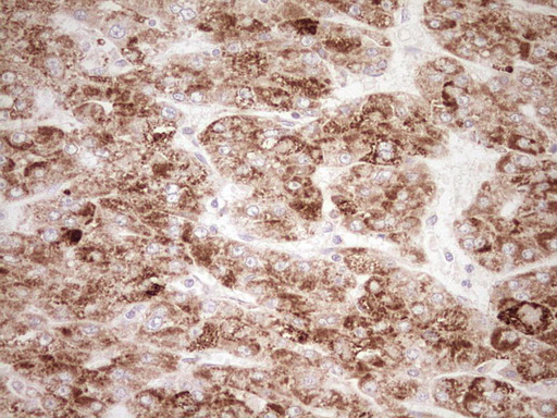 NR0B2 Antibody - Immunohistochemical staining of paraffin-embedded Carcinoma of Human liver tissue using anti-NR0B2 mouse monoclonal antibody. (Heat-induced epitope retrieval by Tris-EDTA, pH8.0) Dilution: 1:150