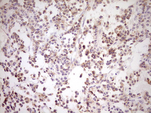 NR0B2 Antibody - Immunohistochemical staining of paraffin-embedded Carcinoma of Human lung tissue using anti-NR0B2 mouse monoclonal antibody. (Heat-induced epitope retrieval by Tris-EDTA, pH8.0) Dilution: 1:150