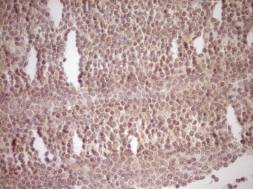 NR0B2 Antibody - Immunohistochemical staining of paraffin-embedded Human lymphoma tissue using anti-NR0B2 mouse monoclonal antibody. (Heat-induced epitope retrieval by Tris-EDTA, pH8.0) Dilution: 1:150