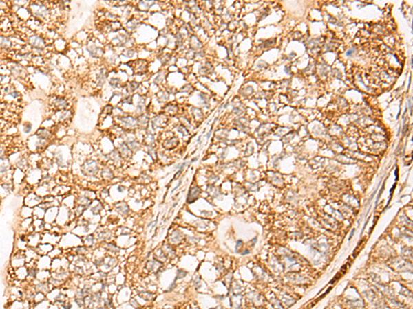 NR0B2 Antibody - Immunohistochemistry of paraffin-embedded Human gastric cancer tissue  using NR0B2 Polyclonal Antibody at dilution of 1:35(×200)