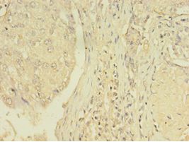 NR1A2 / THRB Antibody - Immunohistochemistry of paraffin-embedded human lung cancer tissue using antibody at 1: 100 dilution.  This image was taken for the unconjugated form of this product. Other forms have not been tested.