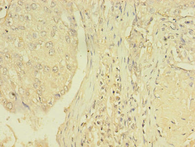 NR1A2 / THRB Antibody - Immunohistochemistry of paraffin-embedded human lung cancer using THRB Antibody at dilution of 1:100