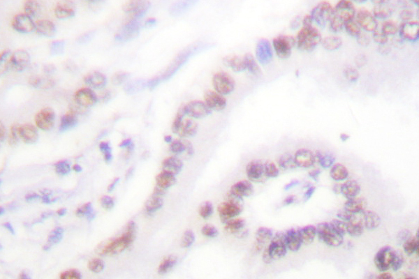 NR1A2 / THRB Antibody - IHC of Thyroid Hormone Receptor (L37) pAb in paraffin-embedded human lung carcinoma tissue.