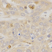 NR1A2 / THRB Antibody - Immunohistochemistry of paraffin-embedded human esophageal cancer using THRB antibody at dilution of 1:200 (x400 lens)