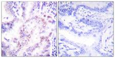 NR1A2 / THRB Antibody - Peptide - + Immunohistochemical analysis of paraffin-embedded human lung carcinoma tissue using Thyroid Hormone Receptor ß antibody.