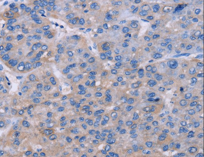 NR1D1 Antibody - Immunohistochemistry of paraffin-embedded Human liver cancer using NR1D1 Polyclonal Antibody at dilution of 1:60.