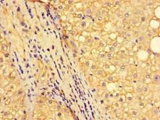 NR1D1 Antibody - Immunohistochemistry of paraffin-embedded human liver cancer at dilution of 1:100