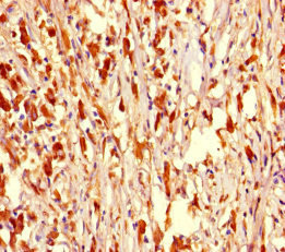 NR1H2 / LXR Beta Antibody - Immunohistochemistry of paraffin-embedded human melanoma cancer at dilution of 1:100