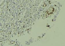 NR1H2 / LXR Beta Antibody - 1:100 staining human breast carcinoma tissue by IHC-P. The sample was formaldehyde fixed and a heat mediated antigen retrieval step in citrate buffer was performed. The sample was then blocked and incubated with the antibody for 1.5 hours at 22°C. An HRP conjugated goat anti-rabbit antibody was used as the secondary.