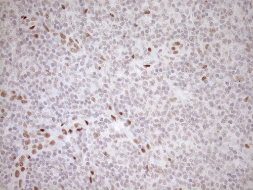 NR1H3 / LXR Alpha Antibody - Immunohistochemical staining of paraffin-embedded Human lymphoma tissue using anti-NR1H3 mouse monoclonal antibody. (Heat-induced epitope retrieval by 1mM EDTA in 10mM Tris buffer. (pH8.5) at 120°C for 3 min. (1:150)