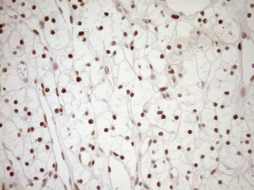 NR1H3 / LXR Alpha Antibody - Immunohistochemical staining of paraffin-embedded Carcinoma of Human kidney tissue using anti-NR1H3 mouse monoclonal antibody. (Heat-induced epitope retrieval by 1mM EDTA in 10mM Tris buffer. (pH8.5) at 120°C for 3 min. (1:150)
