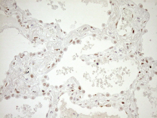 NR1H3 / LXR Alpha Antibody - Immunohistochemical staining of paraffin-embedded Carcinoma of Human lung tissue using anti-NR1H3 mouse monoclonal antibody. (Heat-induced epitope retrieval by 1mM EDTA in 10mM Tris buffer. (pH8.5) at 120°C for 3 min. (1:150)