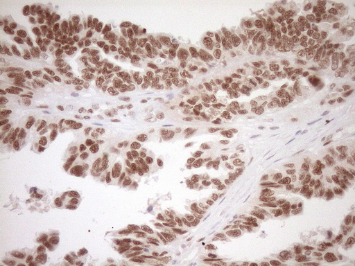 NR1H3 / LXR Alpha Antibody - Immunohistochemical staining of paraffin-embedded Adenocarcinoma of Human ovary tissue using anti-NR1H3 mouse monoclonal antibody. (Heat-induced epitope retrieval by 1mM EDTA in 10mM Tris buffer. (pH8.5) at 120°C for 3 min. (1:150)