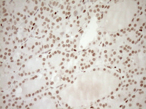 NR1H3 / LXR Alpha Antibody - Immunohistochemical staining of paraffin-embedded Human thyroid tissue within the normal limits using anti-NR1H3 mouse monoclonal antibody. (Heat-induced epitope retrieval by 1mM EDTA in 10mM Tris buffer. (pH8.5) at 120°C for 3 min. (1:150)
