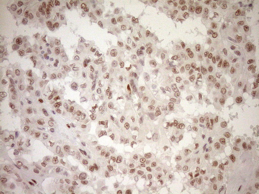 NR1H3 / LXR Alpha Antibody - Immunohistochemical staining of paraffin-embedded Carcinoma of Human thyroid tissue using anti-NR1H3 mouse monoclonal antibody. (Heat-induced epitope retrieval by 1mM EDTA in 10mM Tris buffer. (pH8.5) at 120°C for 3 min. (1:150)
