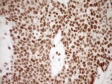 NR1H3 / LXR Alpha Antibody - Immunohistochemical staining of paraffin-embedded Adenocarcinoma of Human endometrium tissue using anti-NR1H3 mouse monoclonal antibody. (Heat-induced epitope retrieval by 1mM EDTA in 10mM Tris buffer. (pH8.5) at 120°C for 3 min. (1:150)