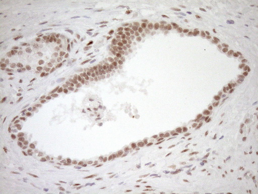 NR1H3 / LXR Alpha Antibody - Immunohistochemical staining of paraffin-embedded Carcinoma of Human prostate tissue using anti-NR1H3 mouse monoclonal antibody. (Heat-induced epitope retrieval by 1mM EDTA in 10mM Tris buffer. (pH8.5) at 120°C for 3 min. (1:150)