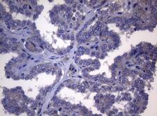 NR1H4 / FXR Antibody - Immunohistochemical staining of paraffin-embedded Carcinoma of Human thyroid tissue using anti-NR1H4 mouse monoclonal antibody. (Heat-induced epitope retrieval by 1mM EDTA in 10mM Tris buffer. (pH8.5) at 120°C for 3 min. (1:150)